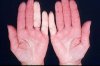 raynaud1.jpg